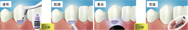 <クリアフィル>による治療方法